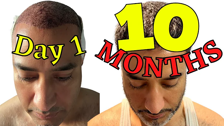 IS HE DISAPPOINTED? FUE Hair Transplant 10 months ...