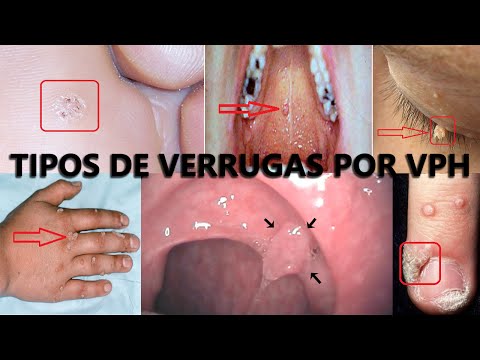 Vídeo: Papiloma En El Párpado: Foto, Eliminación, Causas De Aparición