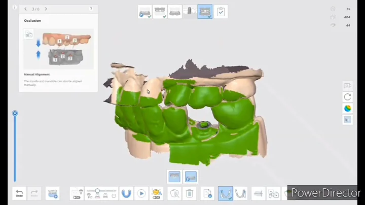 Steps of how to Scan for an Implant Crown Using an Intraoral Scanner Medit i700 and Medit link