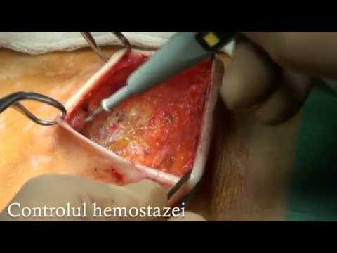 Video: Rezultate Oncologice După Reconstrucția Imediată A Sânului în Urma Mastectomiei: Compararea Implantului și A Clapetei Folosind Potrivirea Scorului De înclinare