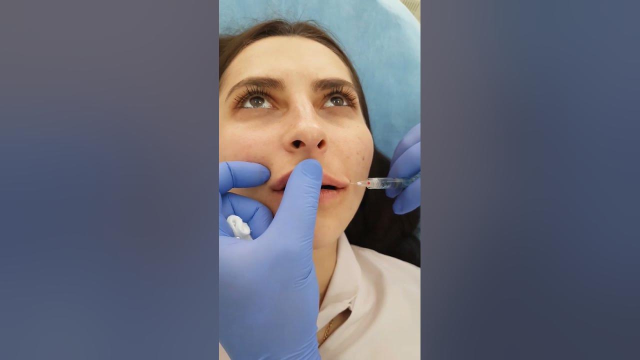 Губы канюлей до и после Галерея Фотографии До и После Уколов Красоты Доктор Эли Шульман