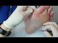 Fixing Wonky Toes