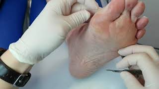 Fixing Wonky Toes