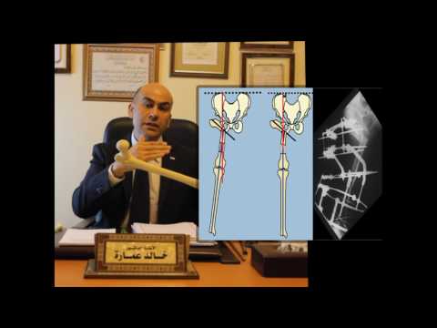 أ.د خالد عمارة  - علاج تشوهات مفصل الفخذ pelvic support osteotomy