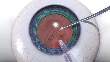Irrigation Aspiration Transformer Animation