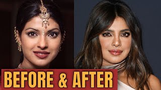 Priyanka Chopra; Plastic (Cosmetic ) Surgery 2020