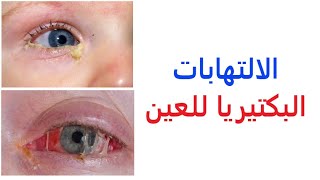 الالتهابات البكتيريا للعين | التهاب الملتحمة | التهاب القرنية