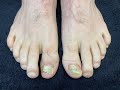 A Testimonial About Dr. Lloyd's Laser Treatment For Fungal Nails (with before and after photos).