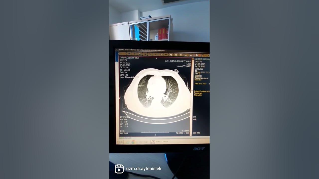 akciğer tomografisinde hangi organlar görülür