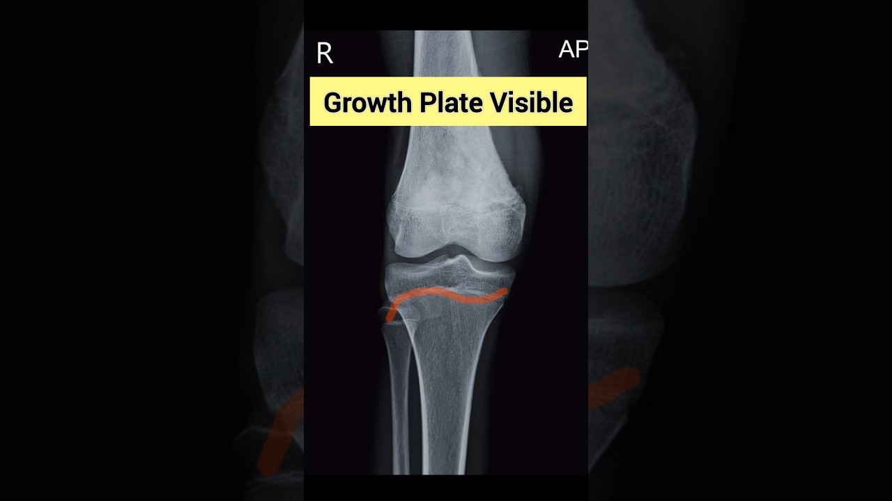 Growth Plate visible in x ray