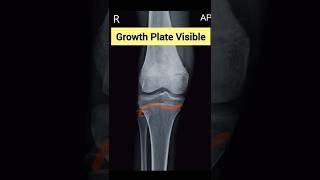 Growth Plate Visible In X Ray