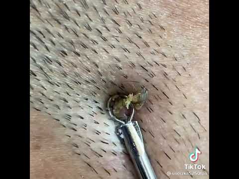 عملية إزالة الرؤوس السوداء من الوجه راحة نفسية دهون الوجه