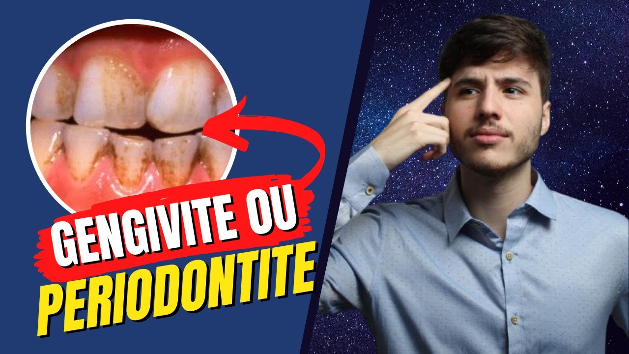 Como saber? | Gengivite ou Periodontite |  Periodontia