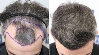 FUE Hair Transplant (2854 Grafts NW III) By Dr Juan Couto - FUEXPERT CLINIC, Madrid, Spain