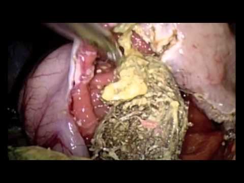 V070 LAPAROSCOPIC MANAGEMENT OF GIANT GASTRIC TRICHOBEZOAR: RAPUNZEL SYNDROME