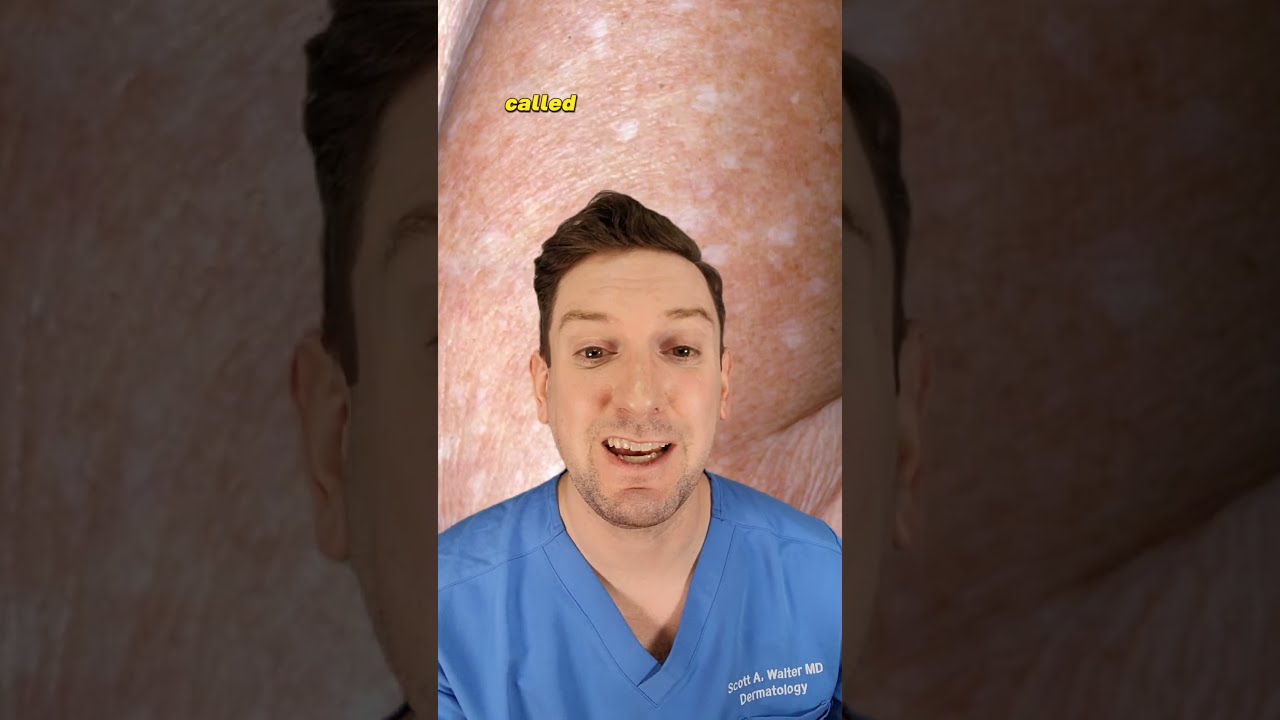 What Are Those White Spots On Your Arms Dermatologist Explains IDIOPATHIC GUTTATE HYPOMELANOSIS