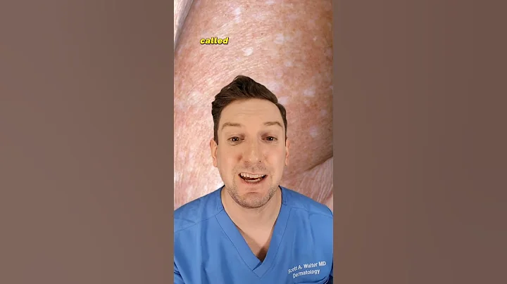 What are those white spots on your arms? Dermatologist explains IDIOPATHIC GUTTATE HYPOMELANOSIS