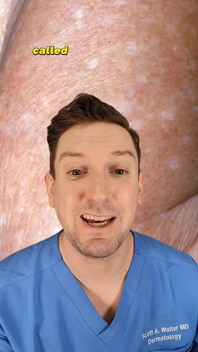 Apa itu bintik-bintik putih di lengan Anda? Dokter kulit menjelaskan HIPOMELANOSIS GUTTATA IDIOPATI