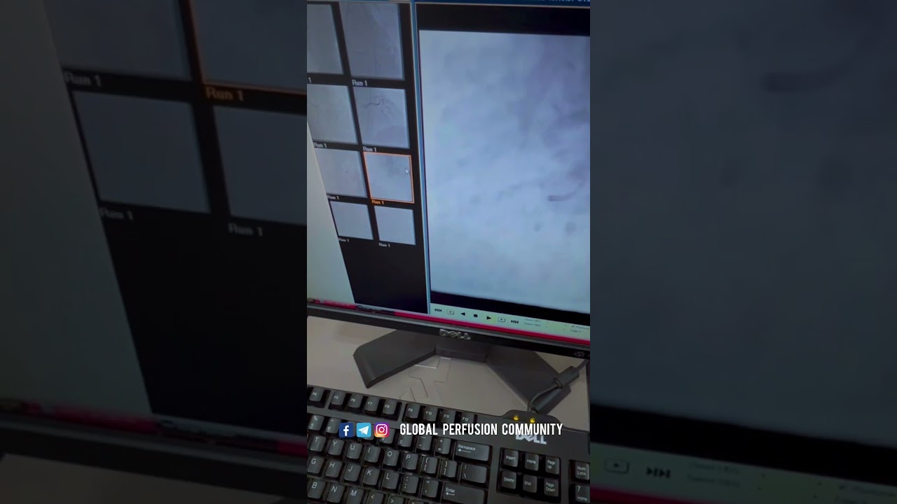 Emergency cardiac bypass Perfusion | clinical Cardiac Perfusionist vlog