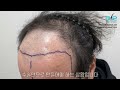 548번 절개가 옛날수술법일까요 절개 4500 모발이식