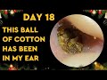 Yellow Earwax Gently Removed Relaxing Music for Sleep & Stress Relief