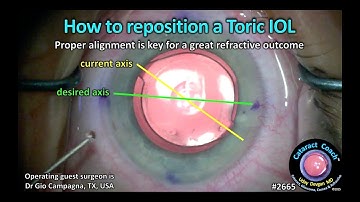 CataractCoach™ 2665: hoe een torische IOL opnieuw te positioneren