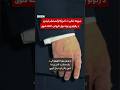 ټرمپ د رګونو په یوې اوږدمهاله ناروغۍ اخته شوی