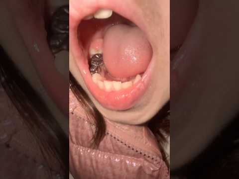 تالين طلعلها ضرس جديد تمها ورمان من البنج