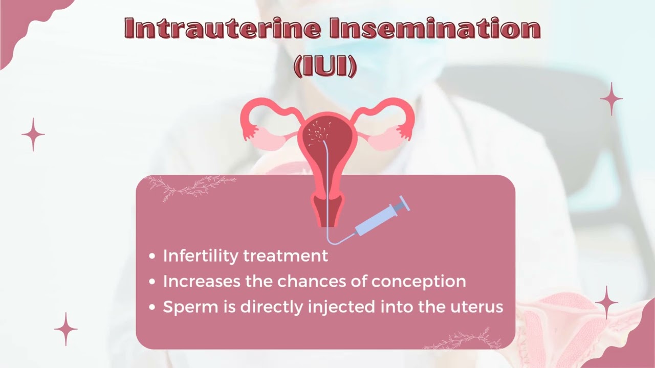 Intrauterine insemination (IUI) is a fertility treatment where washed and prepared sperm is direc...