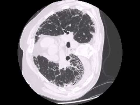 Loculated pleural effusion, honeycombing of lung - YouTube