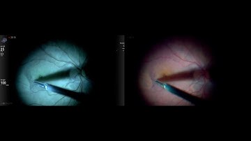 Simultaneous comparison of Ngenuity regular view VS Digital filtering for ILM peeling Lukan Mishev