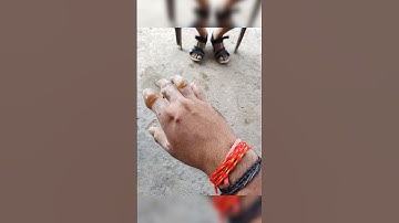 firecrackers accident #handburn #firecracker #anar #blast #burst #accidentnews
