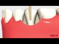 Luxator titanium directa dental