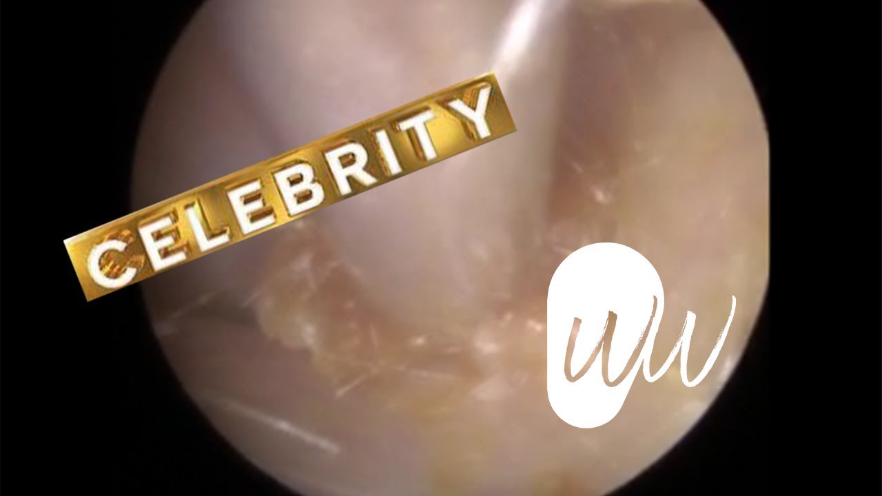 CELEBRITY EAR WAX REMOVAL & SKIN PEEL WITH VIDEO TESTIMONIAL 491