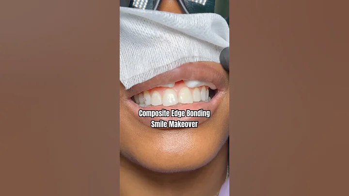 Composite Edge Bonding is the Rolls Royce of Composite Bonding treatments! #smilemakeover #veneers