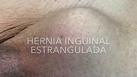 Quais os sintomas de hérnia estrangulada?