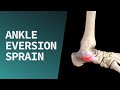 Ankle eversion sprain