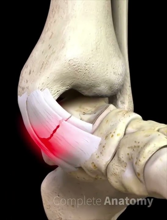 Ankle Eversion Sprain