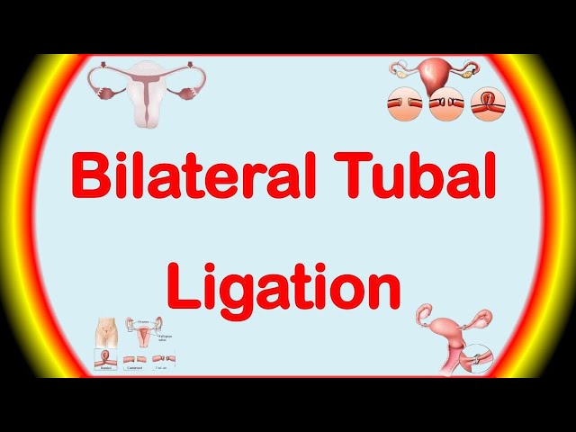 Bilateral Tubal Ligation Tagalog