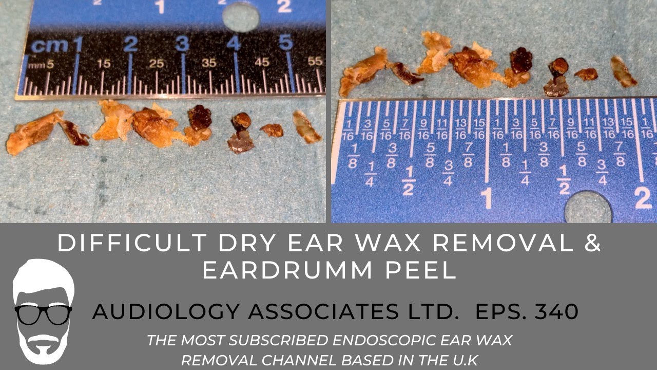 DIFFICULT DRY EAR WAX REMOVAL & EARDRUM PEEL EP340 YouTube
