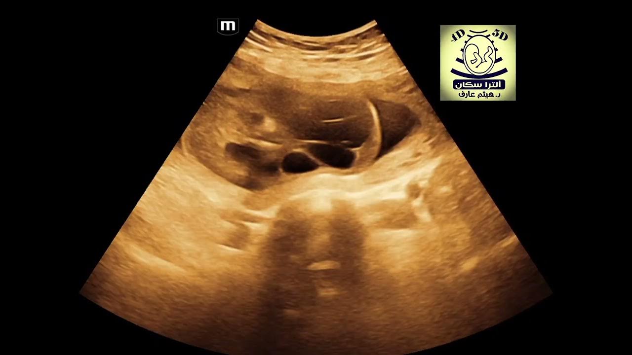 Cystic hygroma with hydrops fetalis fetal ultrasound youtube