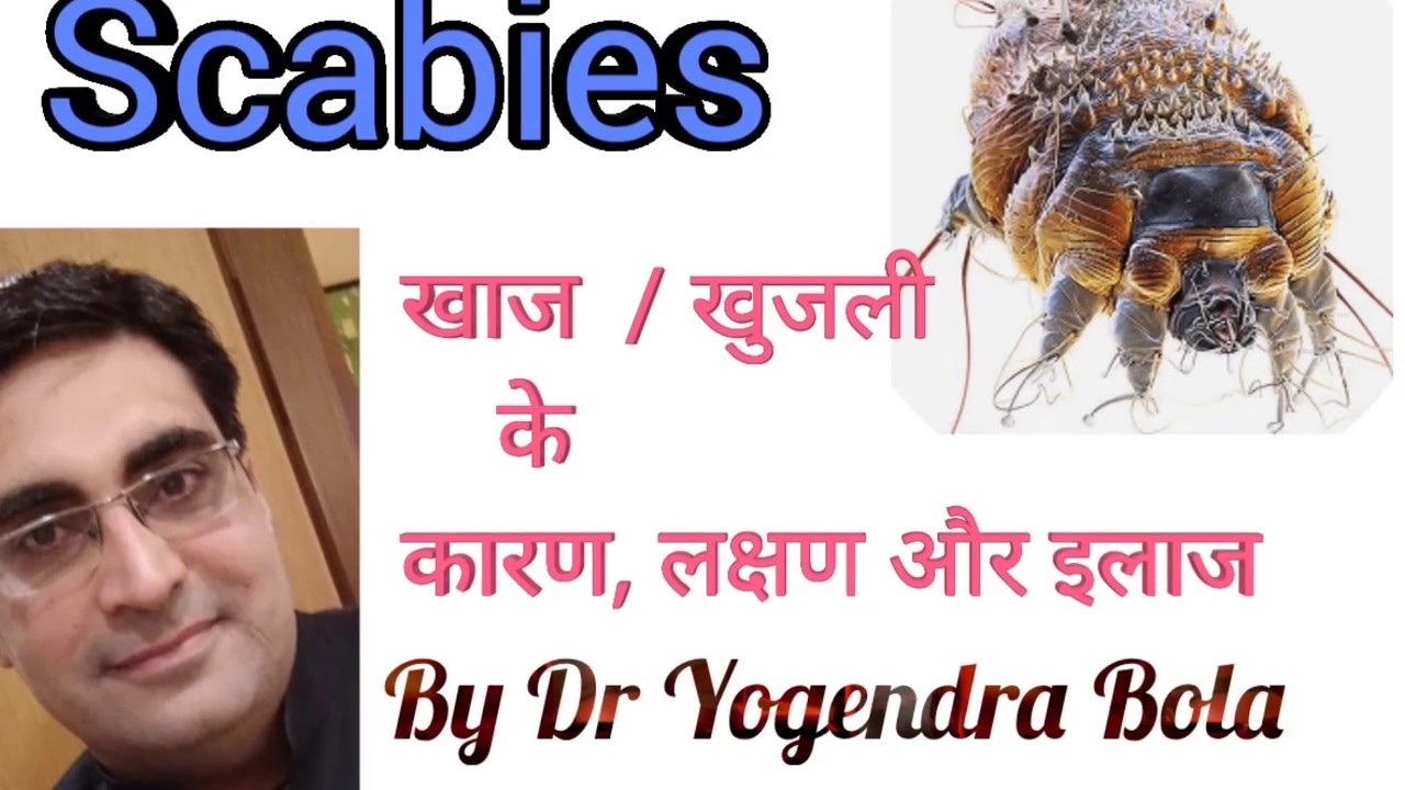 SCABIES -COMPLETE  CURE and treatment  by DR YOGENDRA BOLA  in  hindi.रात को होने वाली खुजली का इलाज