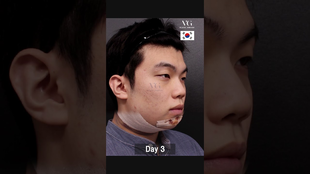 [ВЭРИ ГҮҮД ГОО САЙХНЫ МЭС ЗАСЛЫН ЭМНЭЛЭГ] #ЭрэгтэйӨмнөХойно #ГооСайхныМэсЗаслынӨмнөХойно Эрэгтэйчүүд ч бас өөрийгөө арчлах цаг үе. Урагш цойсон эрүү биш, харин нарийхан, цэмцгэр лайнтай болоорой.