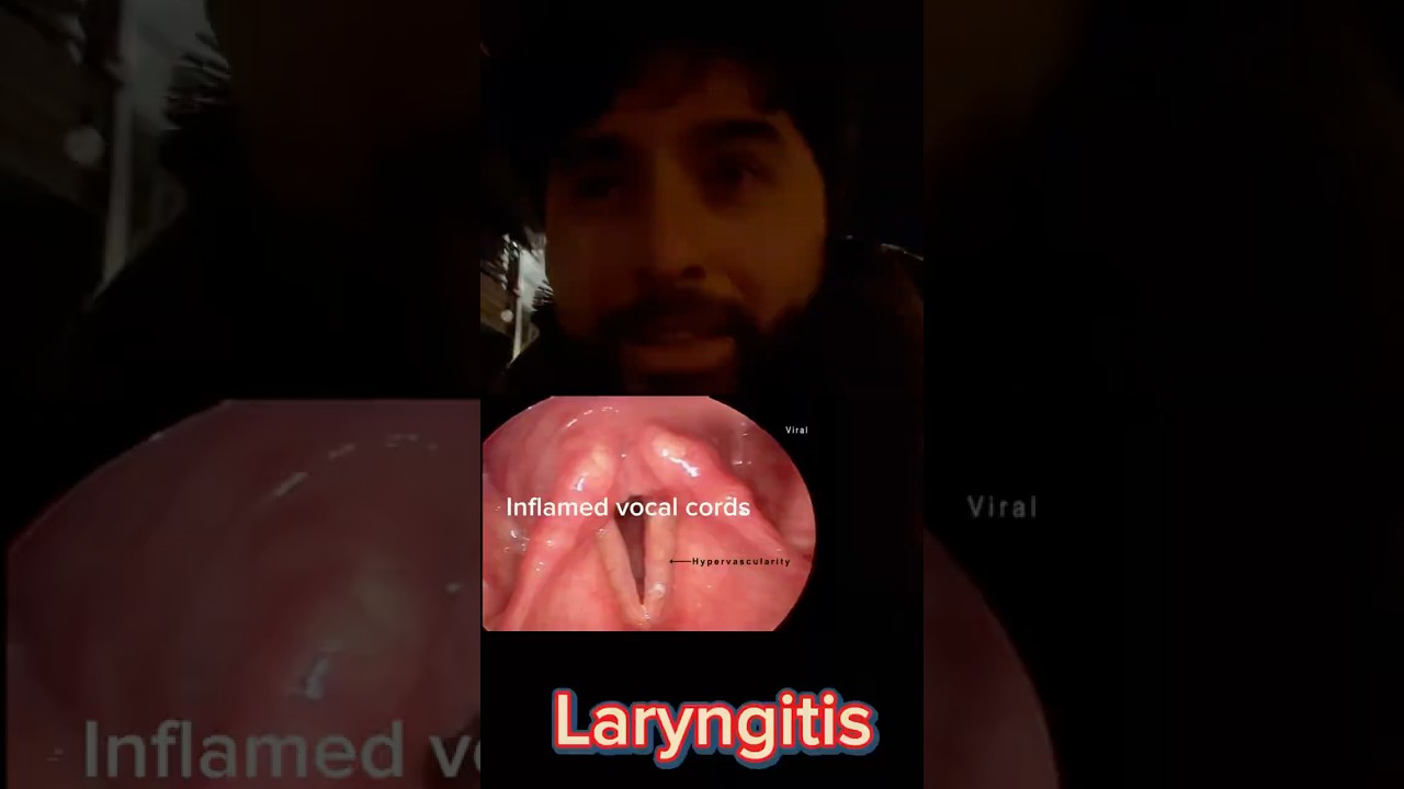 Laryngitis: what it is, how to manage and why you probably don’t need antibiotics 