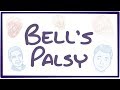 Bell's Palsy - causes, symptoms, diagnosis, treatment, pathology