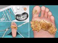 ASMR | Surgery to Remove Large Plantar Warts Animation | Corn Foot Calluse HPV Treatment 사마귀 足底疣贅