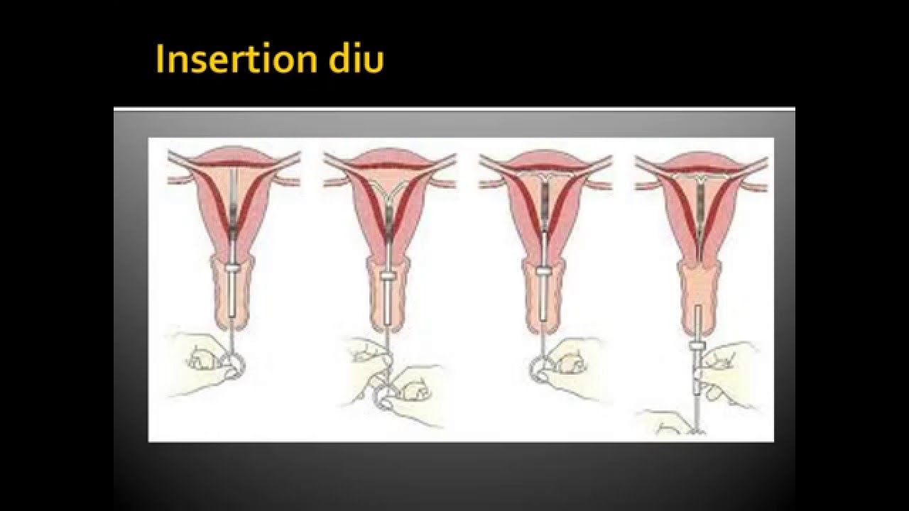 GYNECOLOGIE Contraception mécanique dispositifs intra utérins - YouTube