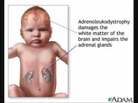 Ald automotive logo. Адренолейкодистрофия. Х алд. X сцепленная адренолейкодистрофия. Х алд.