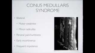 Review of Conus Medullaris Syndrome vs. Cauda Equina Syndrome