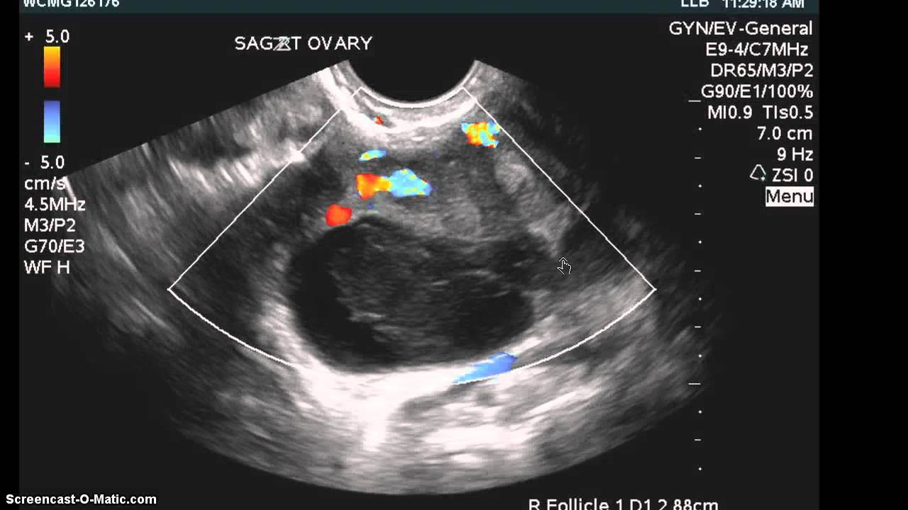 Hemorrhagic Cyst Mri